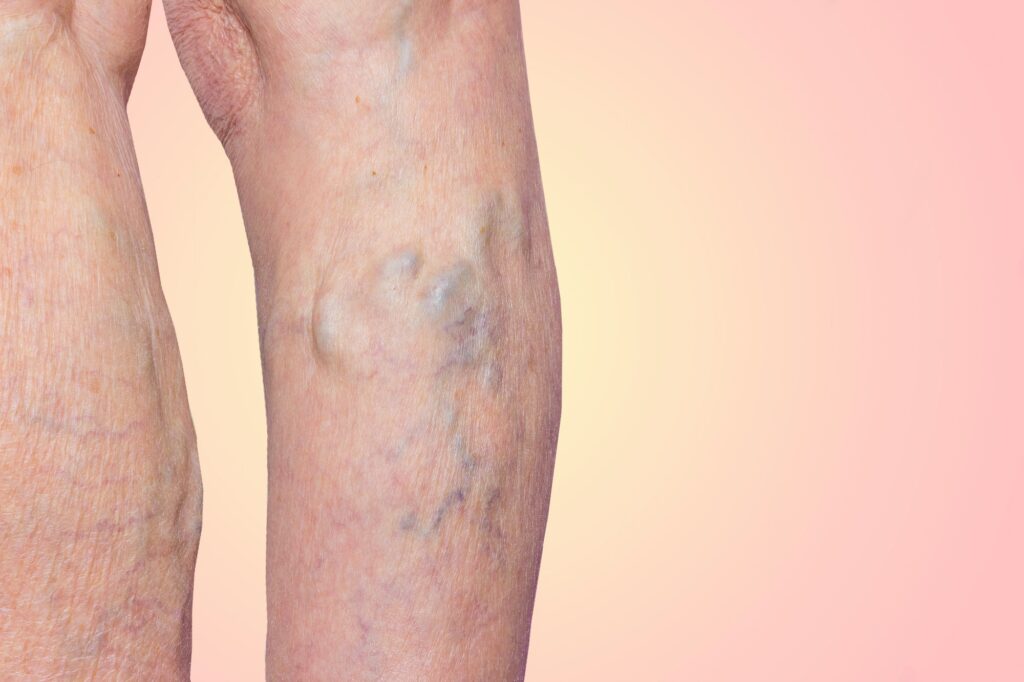 VARITHENA IN LOS ANGELES, CA