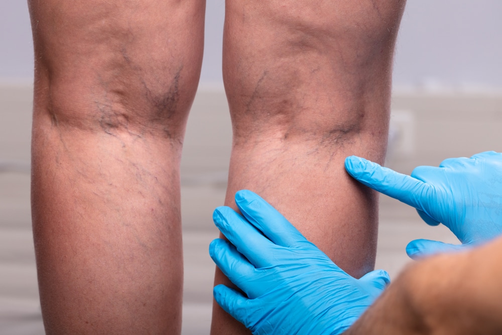 Close up of woman's legs as she holds them due to varicose veins in Los Angeles, CA Healthcare provider examining visible spider veins and varicose veins on a patient's lower legs.