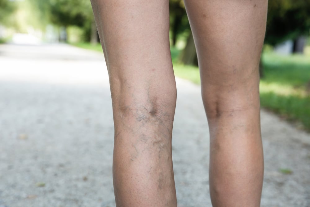 Close up of woman's legs as she holds them due to varicose veins in Los Angeles, CA Visible varicose veins on the lower legs, showing a common sign of vein disease and circulation problems.