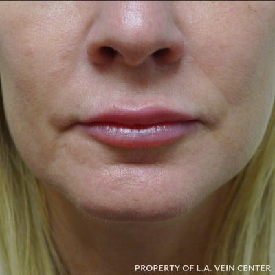 After Image: Lip Filler