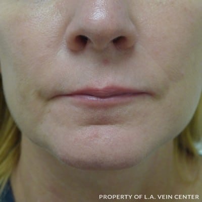 Before Image: Lip Filler