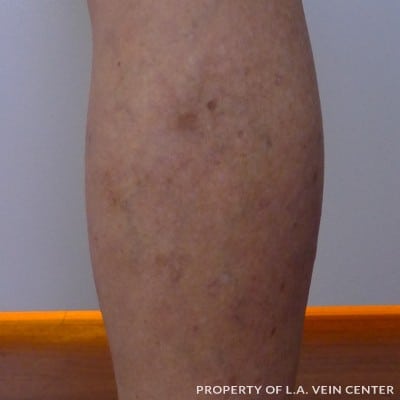After Image: Varicose Vein Right Leg - back