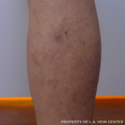 Varicose Vein Right Leg