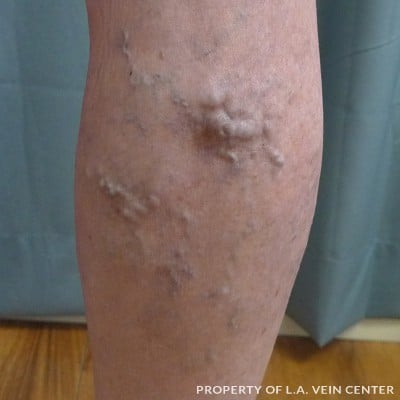 Before Image: Varicose Vein Right Leg - back