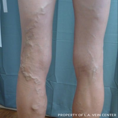 Before Image: Varicose Veins Left Leg - back