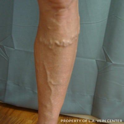 Before Image: Varicose Veins Left Leg - front