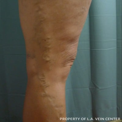 Before Image: Varicose Veins Right Leg - right-side