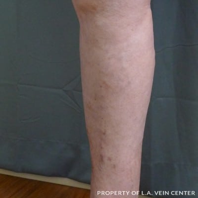 After Image: Varicose Veins Inner Right Leg - other