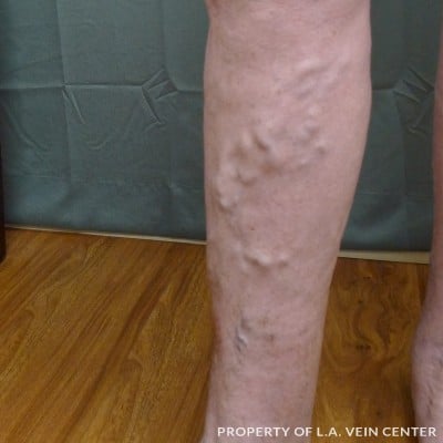 Before Image: Varicose Veins Inner Right Leg - other