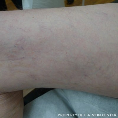 After Image: Spider Veins Inner Right Leg - right-side