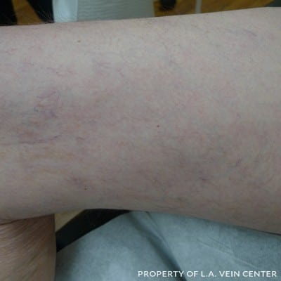 Spider Veins Inner Right Leg