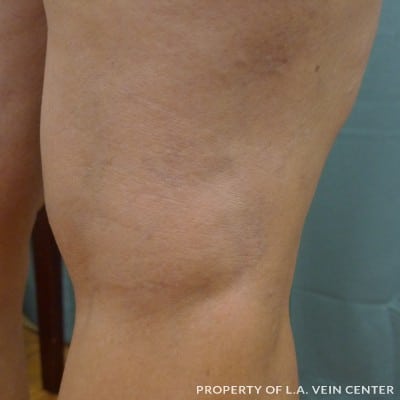 Spider Veins Back of Right Leg