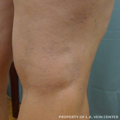 After Image: Spider Veins Back of Right Leg - back