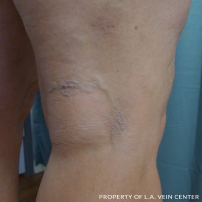 Before Image: Spider Veins Back of Right Leg - back