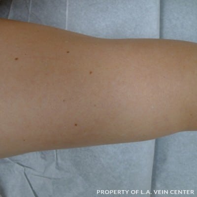 After Image: Spider Veins Back Leg - back
