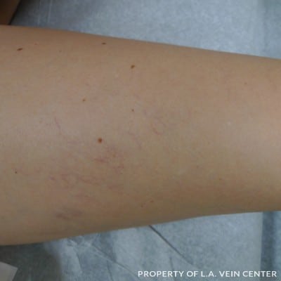 Before Image: Spider Veins Back Leg - back