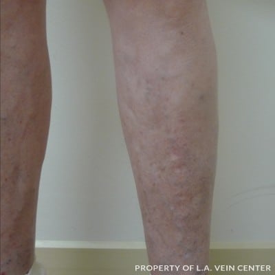 After Image: Varicose Veins Lower Left Leg - front