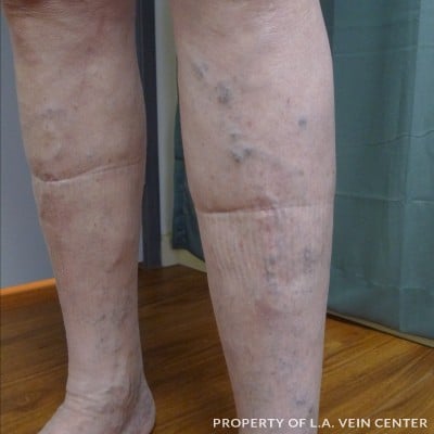 Before Image: Varicose Veins Lower Left Leg - front