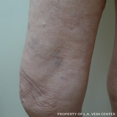 After Image: Vericose Veins Upper Right Leg - front