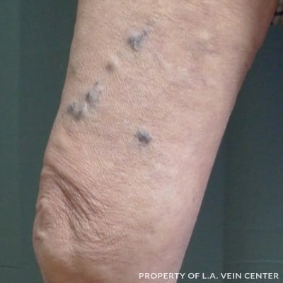 Before Image: Vericose Veins Upper Right Leg - front
