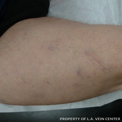 After Image: Varicose Veins Upper Right Leg - front