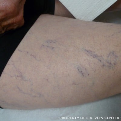 Before Image: Varicose Veins Upper Right Leg - front