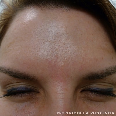 After Image: Forehead Treatment - front