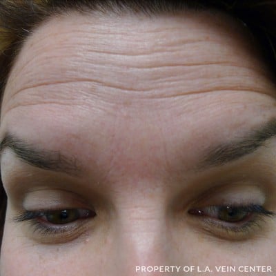 Before Image: Forehead Treatment - front