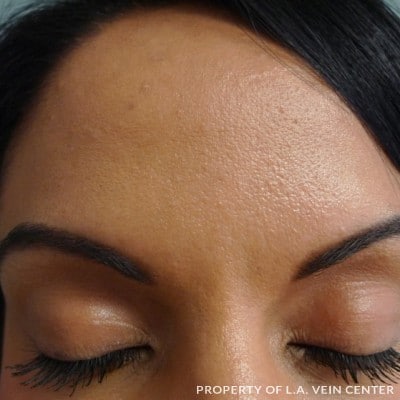 Forehead Treatment