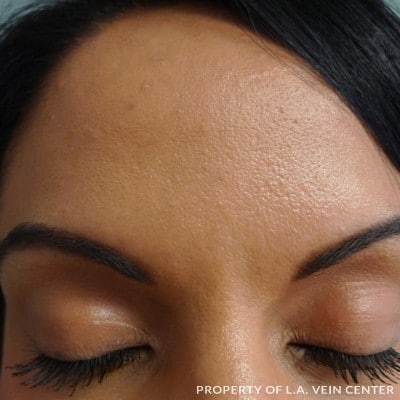 After Image: Forehead Treatment - front