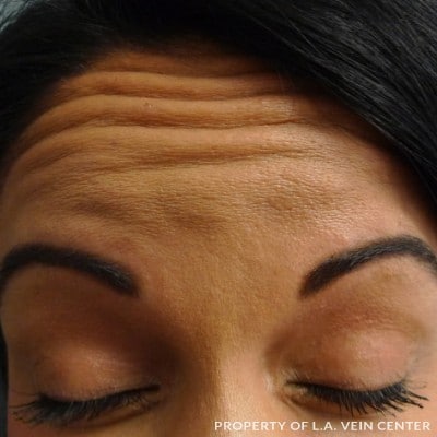 Before Image: Forehead Treatment - front
