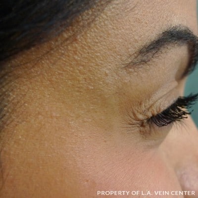 After Image: Crows Feet Treatment - front