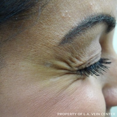 Before Image: Crows Feet Treatment - front