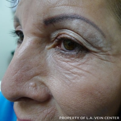 Before Image: Facial Treatment - left-front-oblique