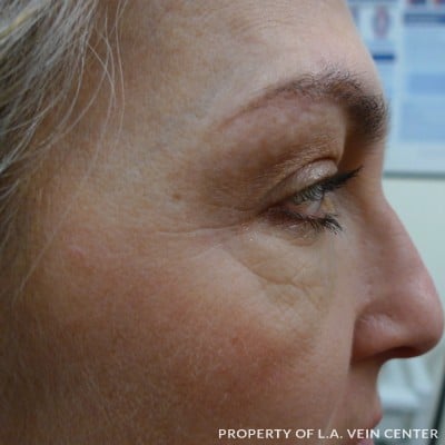 After Image: Wrinkles Treatment