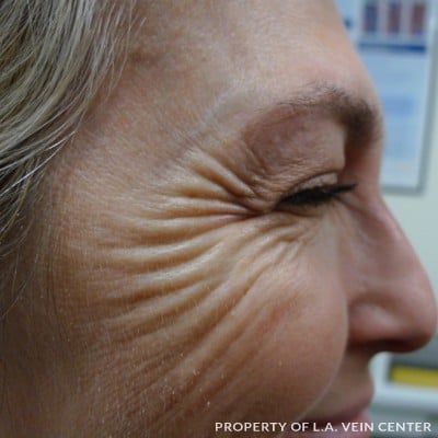 Before Image: Wrinkles Treatment