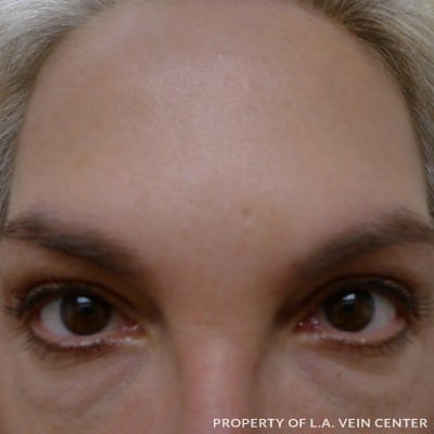 After Image: Wrinkles Treatment - front