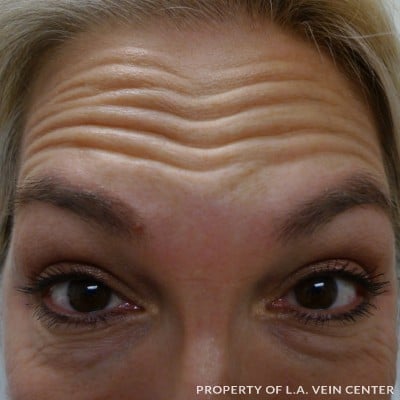 Wrinkles Treatment