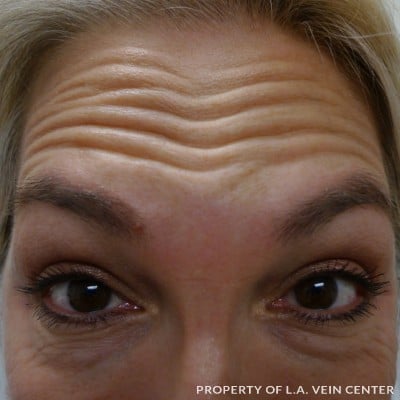 Before Image: Wrinkles Treatment - front