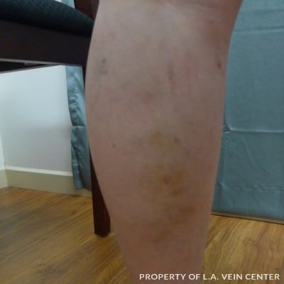 After Image: Phlebectomy - back