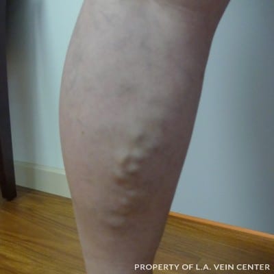 Before Image: Phlebectomy - back