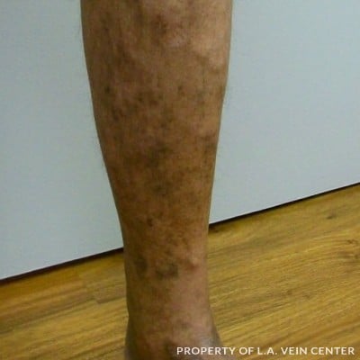 After Image: Radio Frequency Ablation Varicose - front