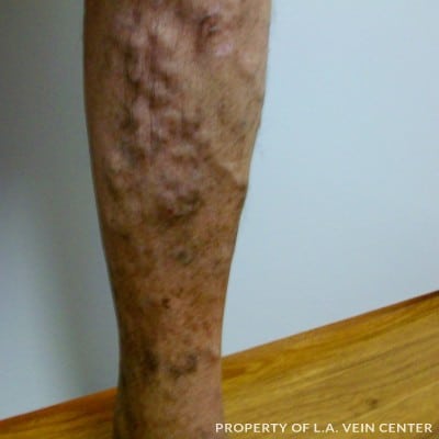 Before Image: Radio Frequency Ablation Varicose - front