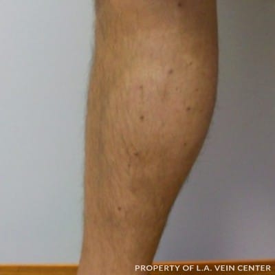 After Image: Varicose Vein Treatment - left-side