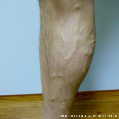 Before Image: Varicose Vein Treatment - left-side