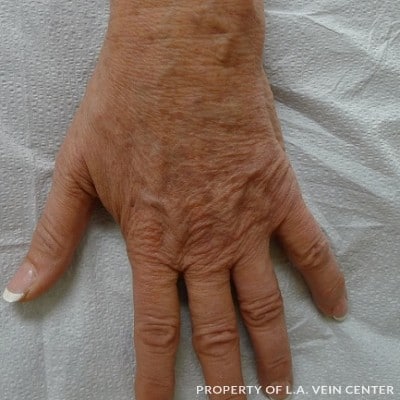 After Image: Hand Vein Filler Treatment - front