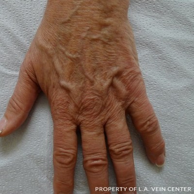 Before Image: Hand Vein Filler Treatment - front