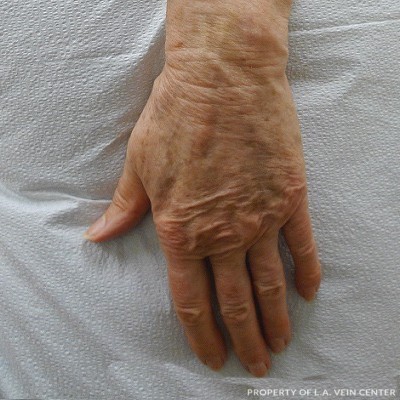After Image: Hand Vein Sclerotherapy - front