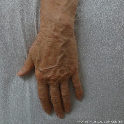 Before Image: Hand Vein Sclerotherapy - front