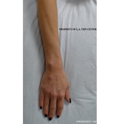 After Image: Hand Vein Phlebectomy - front